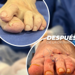 Historias de recuperación tras cirugía mínimamente invasiva del pie